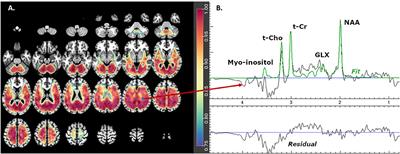 Increased Glutamate Plus Glutamine in the Right Middle Cingulate in Early Schizophrenia but Not in Bipolar Psychosis: A Whole Brain 1H-MRS Study